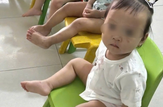 Tình trạng sức khỏe bé gái 1 tuổi bị bầm tím mặt khi gửi nhà trẻ ở Bắc Ninh