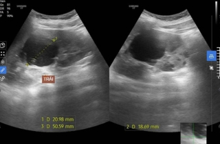 Nam sinh 15 tuổi khỏe mạnh đi khám phát hiện bị bệnh lý ba đời cùng mắc