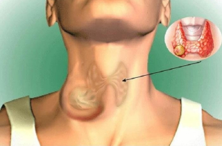 Mẹ đưa con gái đi khám vì khàn tiếng, cả hai phát hiện cùng mắc ung thư