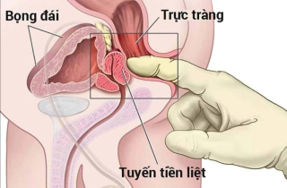 Triệu chứng điển hình của phì đại tuyến tiền liệt