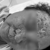 Nổi mụn nước tưởng dị ứng da, không ngờ nhiễm virus gây biến chứng nguy hiểm