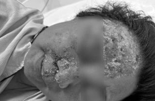 Nổi mụn nước tưởng dị ứng da, không ngờ nhiễm virus gây biến chứng nguy hiểm