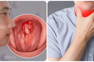 9 dấu hiệu ung thư vòm họng giai đoạn đầu