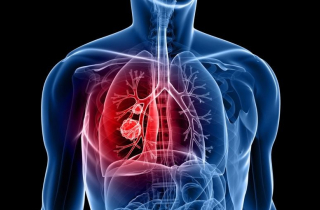 5 dấu hiệu liên quan đến ung thư phổi không nên bỏ qua