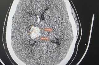 Xử trí thành công một ca hội chứng mạch máu hiếm gặp