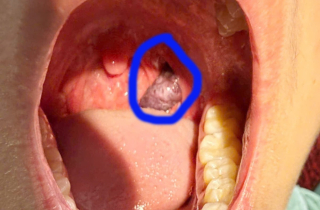 Cứu bé trai 14 tuổi mắc u máu amidan hiếm gặp, nguy cơ chèn ép đường thở