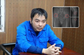 Cựu nhân viên y tế đục vỡ xương trục lợi bảo hiểm: Thủ đoạn tàn nhẫn, bất nhân