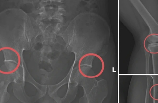 Tự đục vỡ xương để trục lợi bảo hiểm: Quá sợ kẻ vì tiền mà độc ác với chính mình