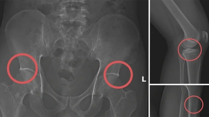 Tự đục vỡ xương để trục lợi bảo hiểm: Quá sợ kẻ vì tiền mà độc ác với chính mình