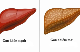 Người bị xơ gan, gan nhiễm mỡ do rượu bao lâu nên khám một lần?