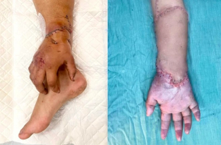 Bàn tay đứt lìa của mẹ bầu được nối lại sau thời gian 'nuôi' ở chân