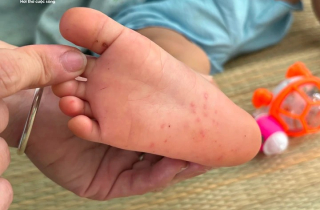 Tác nhân EV71 tái xuất, nguy cơ bùng phát dịch tay chân miệng ở TP.HCM