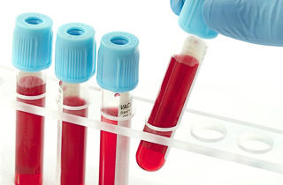 Xét nghiệm dấu ấn ung thư có phát hiện được bệnh?