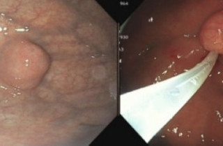 Phát hiện khối u dạ dày 1,4 cm khi đi khám sức khỏe định kỳ