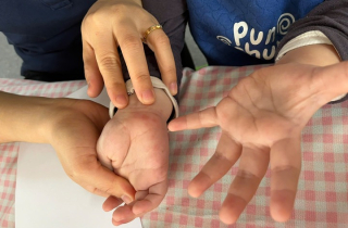 Tưởng con sốt phát ban, bà mẹ tá hỏa khi bác sĩ kết luận tay chân miệng