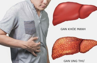 Ung thư gan có chữa khỏi?