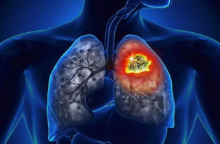 Vì sao ung thư phổi có tỷ lệ tử vong cao?