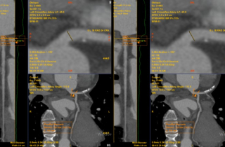Chỉ đau tức ngực trái thoáng qua, không ngờ phát hiện bệnh lý tim mạch nguy hiểm