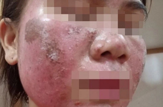 'Vỡ mộng' da đẹp đón Tết: Tan nát mặt vì tự peel da theo hướng dẫn trên mạng